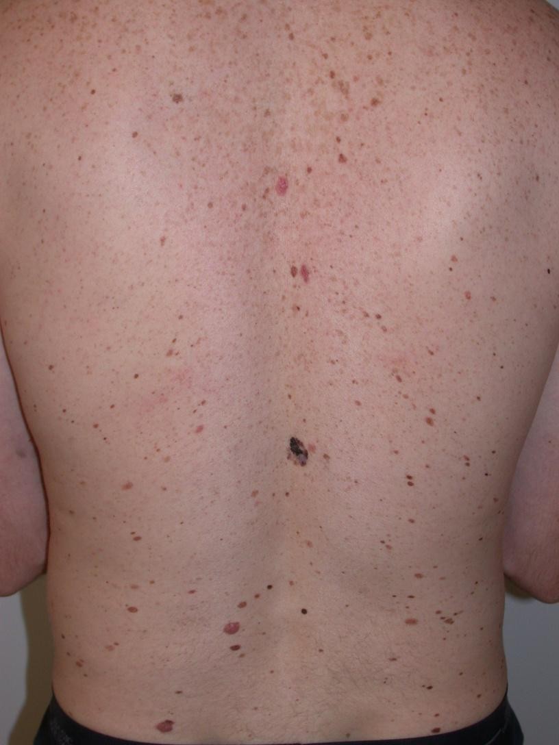 melanome 02.jpg (105 KB)