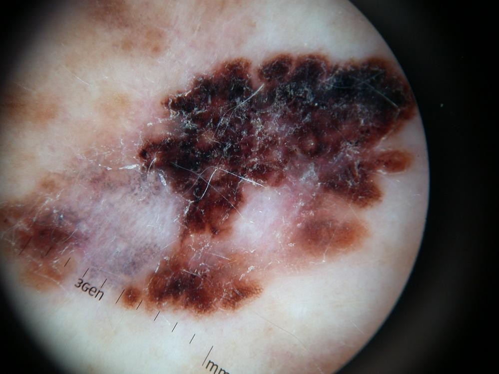 melanome.jpg (102 KB)